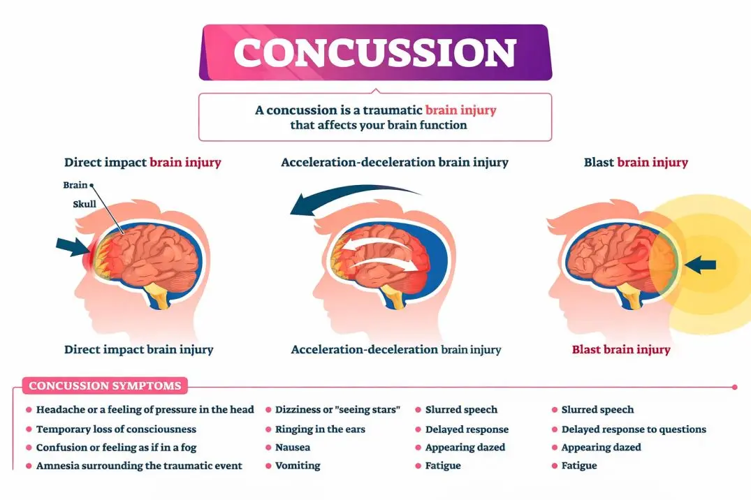concussion therapy syndrome