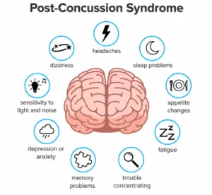 post concussion syndrome